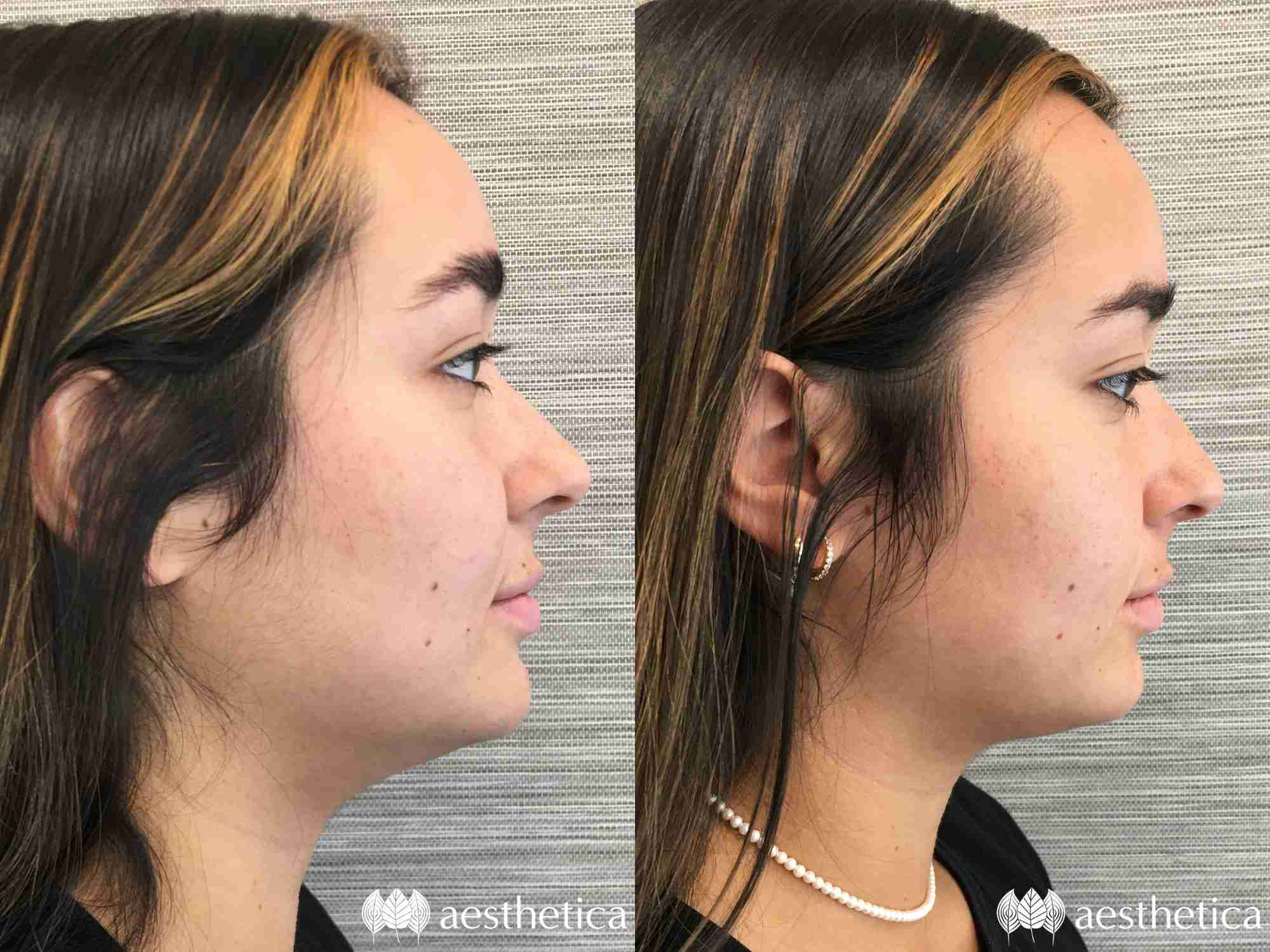 kybella utah