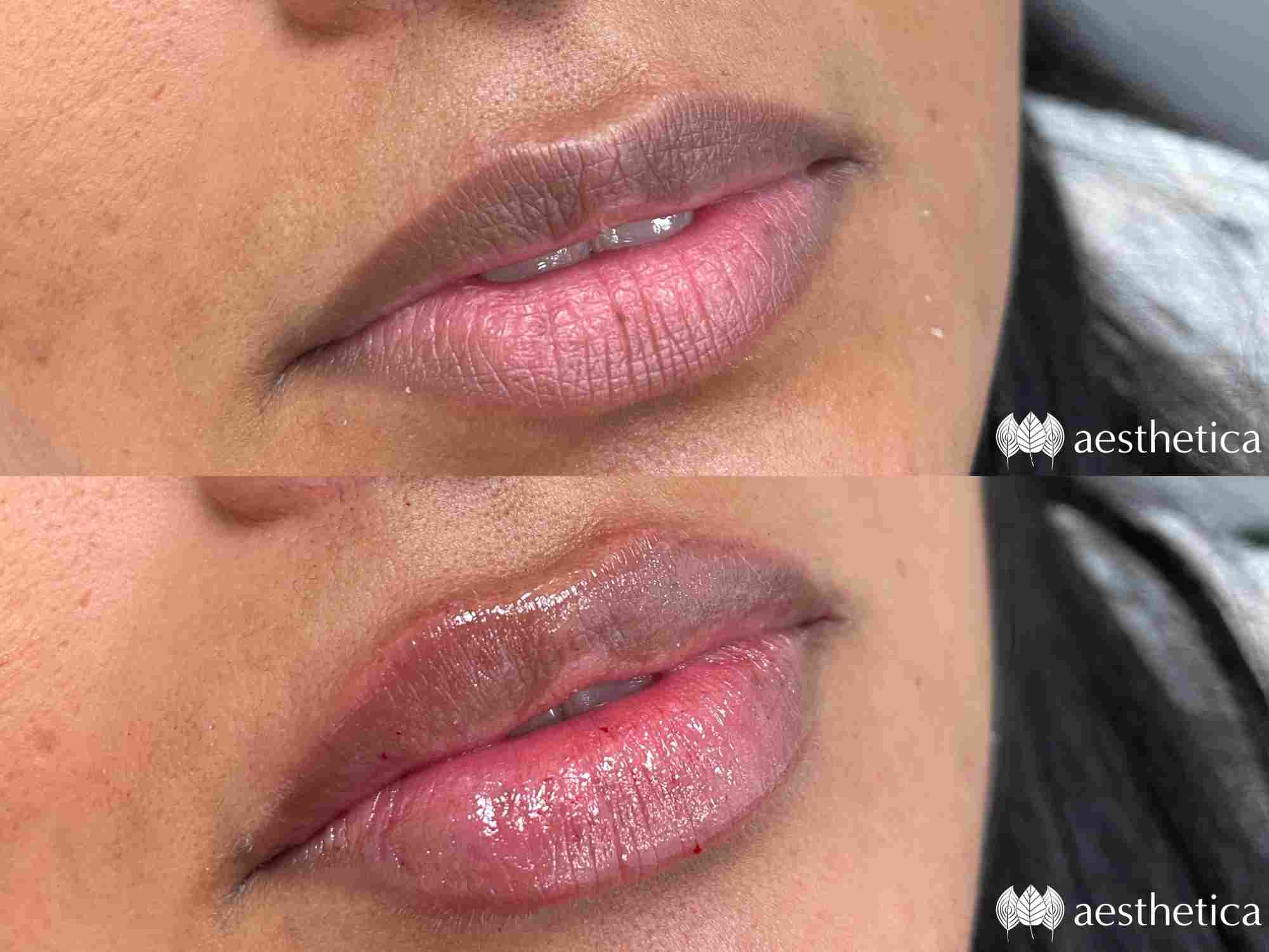 lip-filler-by-alyse