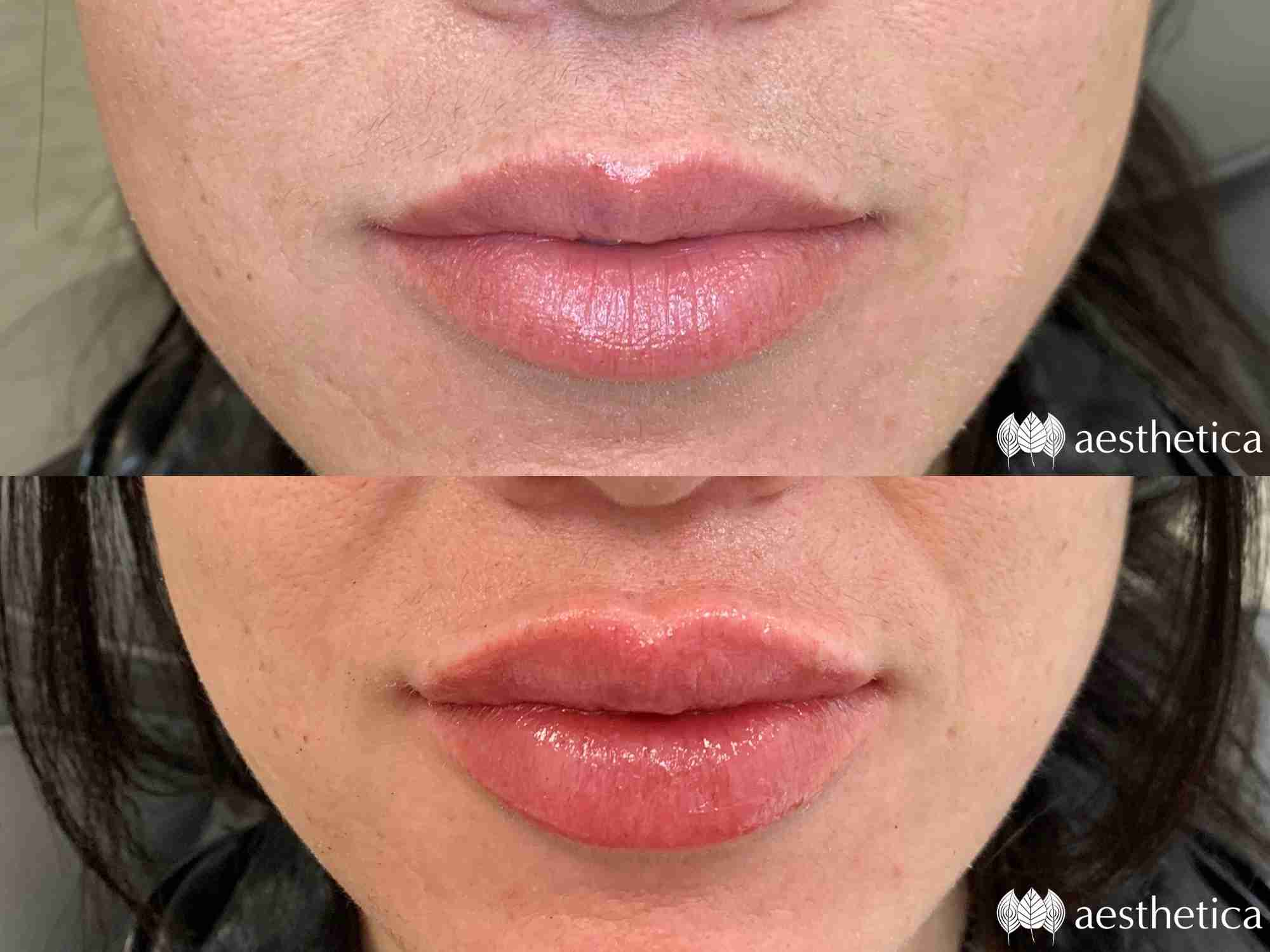 lip injections utah