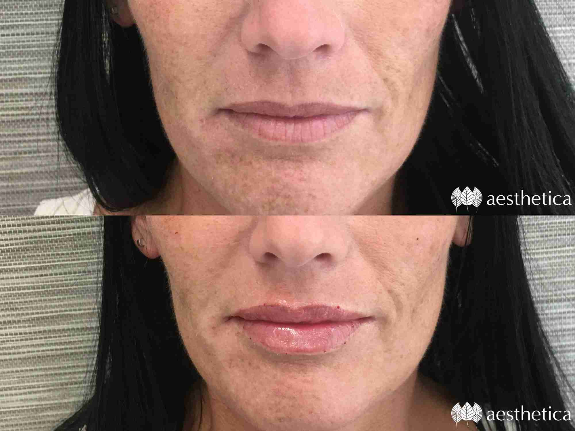 natural lip filler