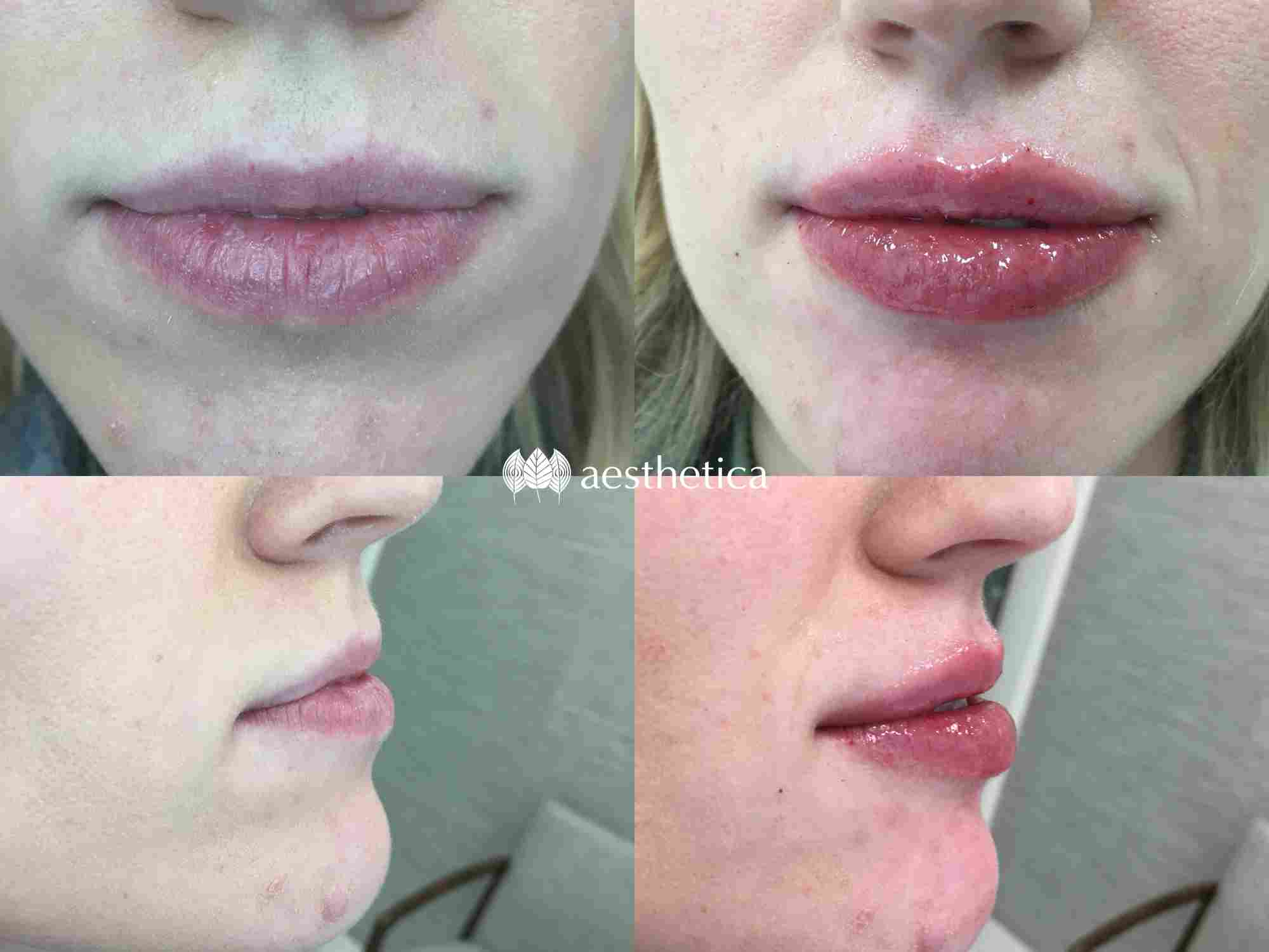 lippie-collage-alyse