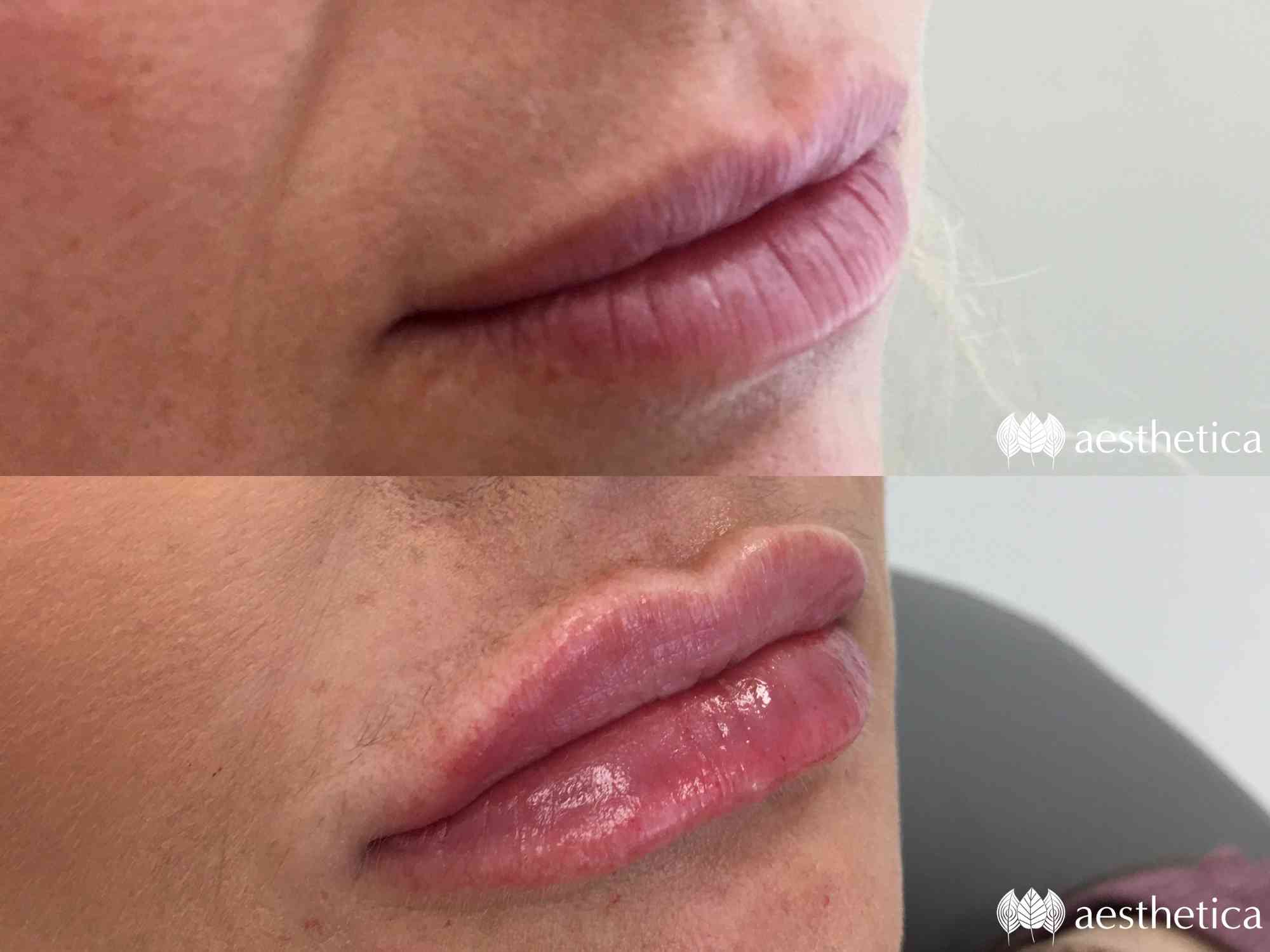 juvederm lip filler