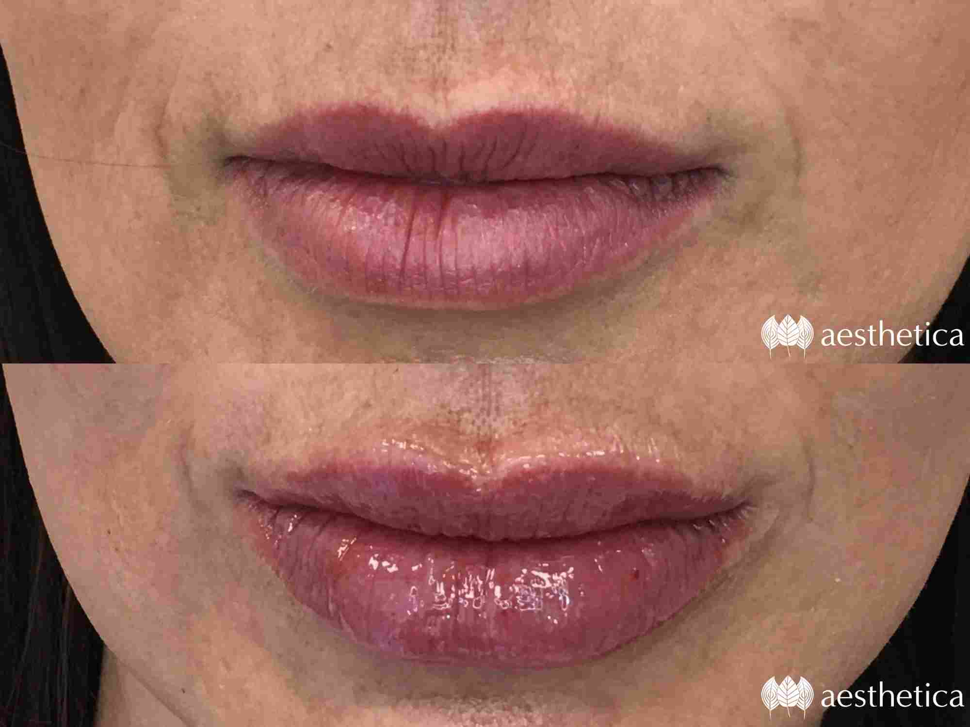 lip injections utah