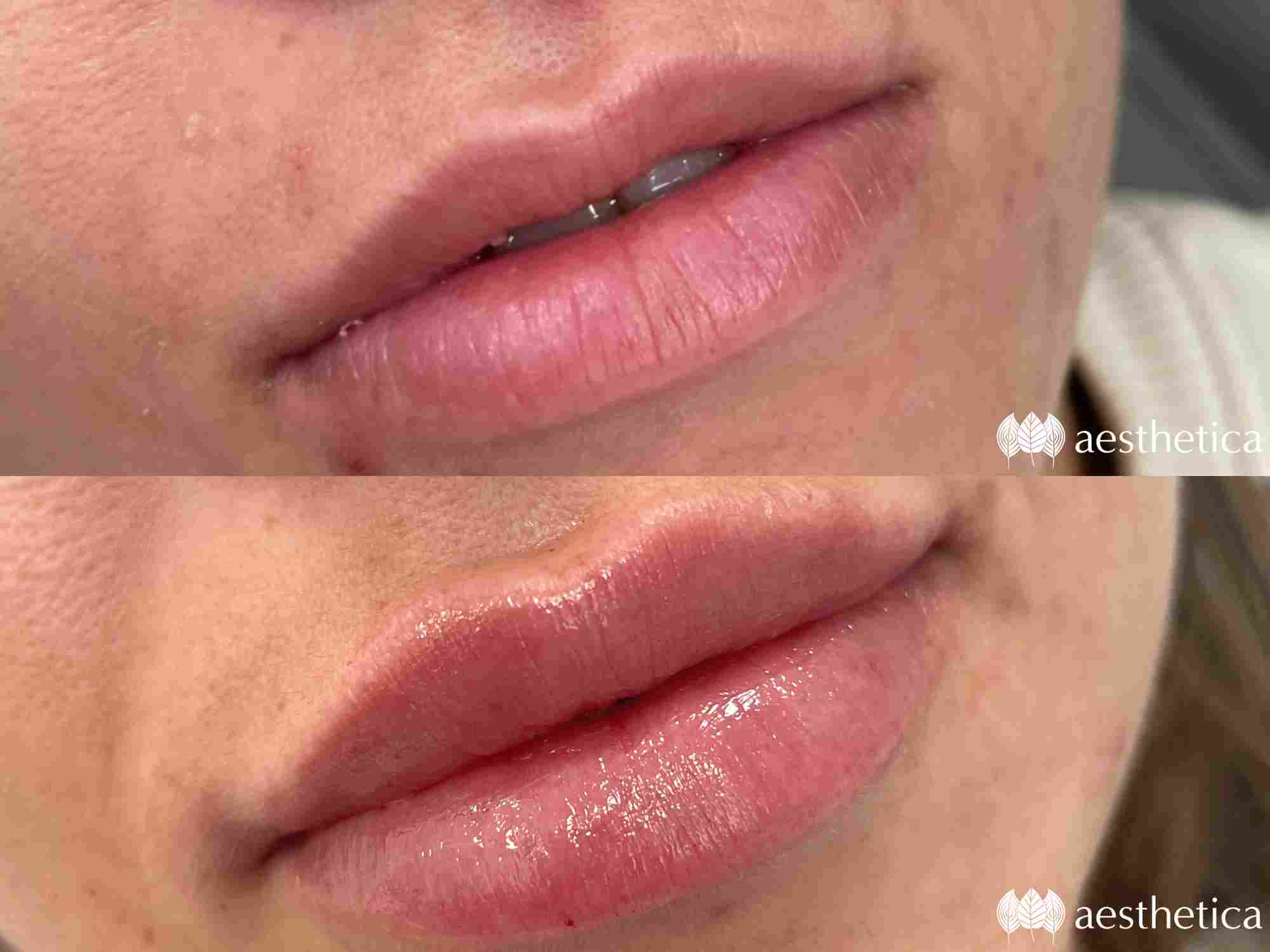 plump-lips-by-alyse