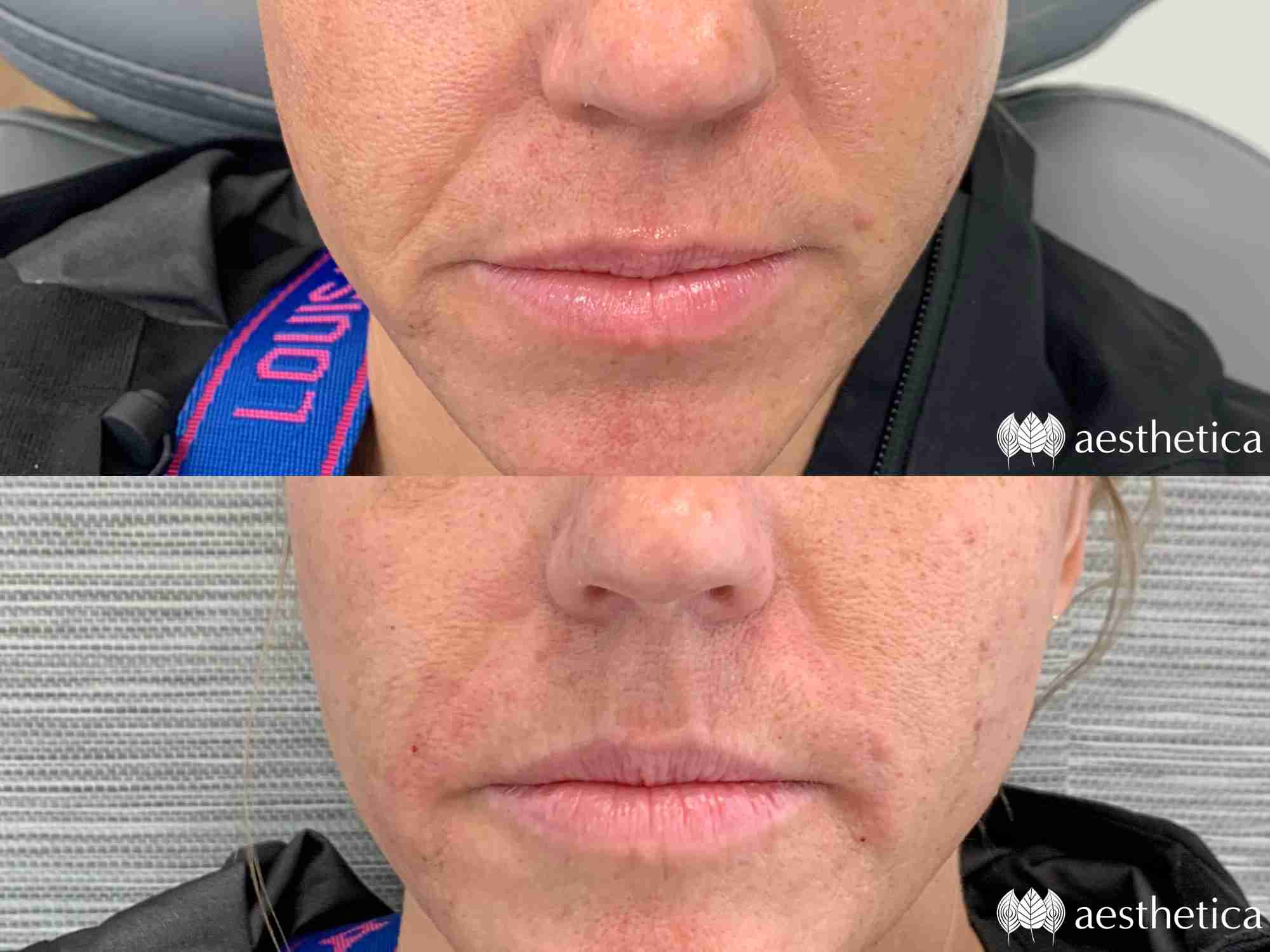 nasolabial fold line treatment utah