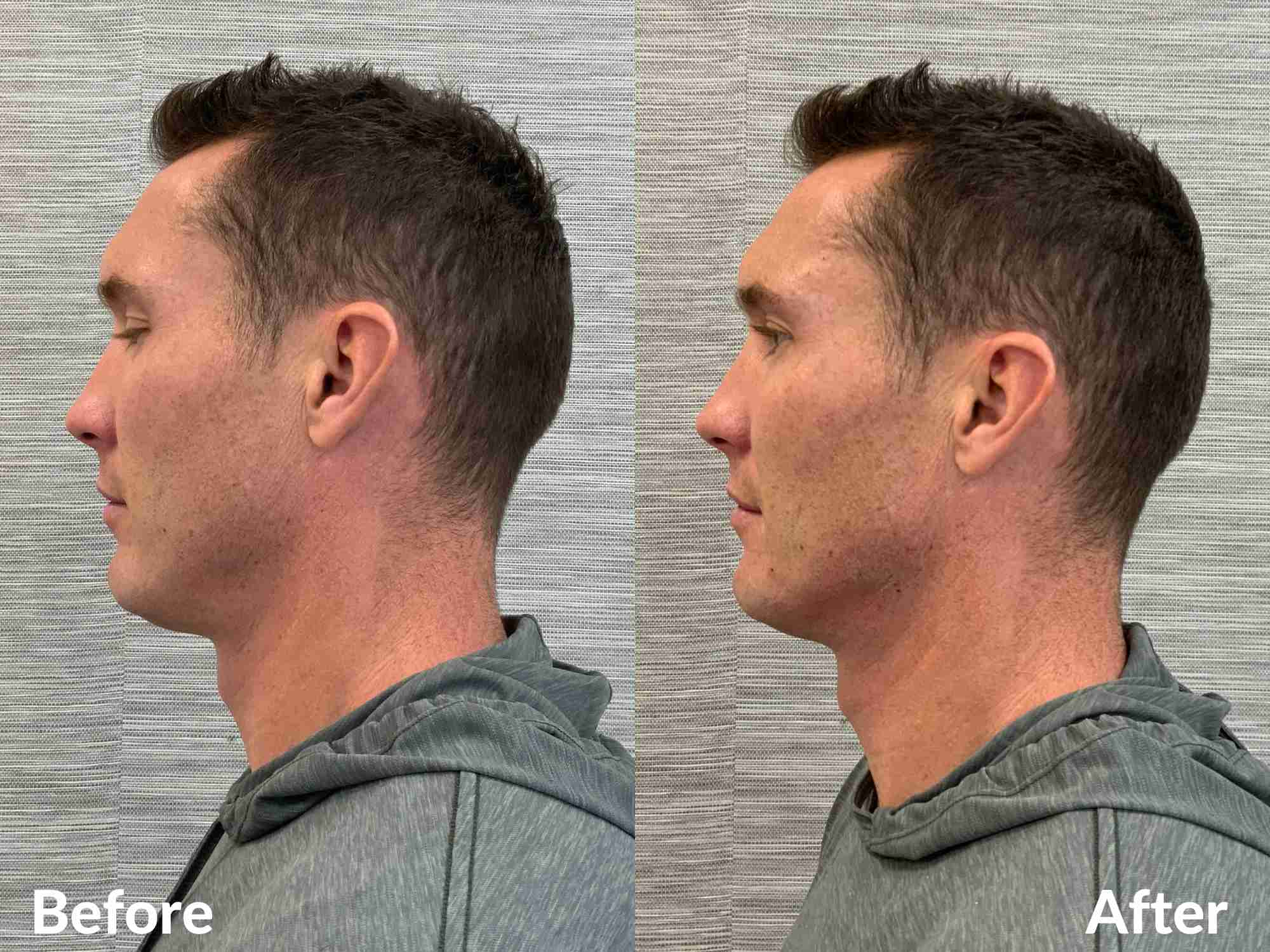 male jawline filler with volux