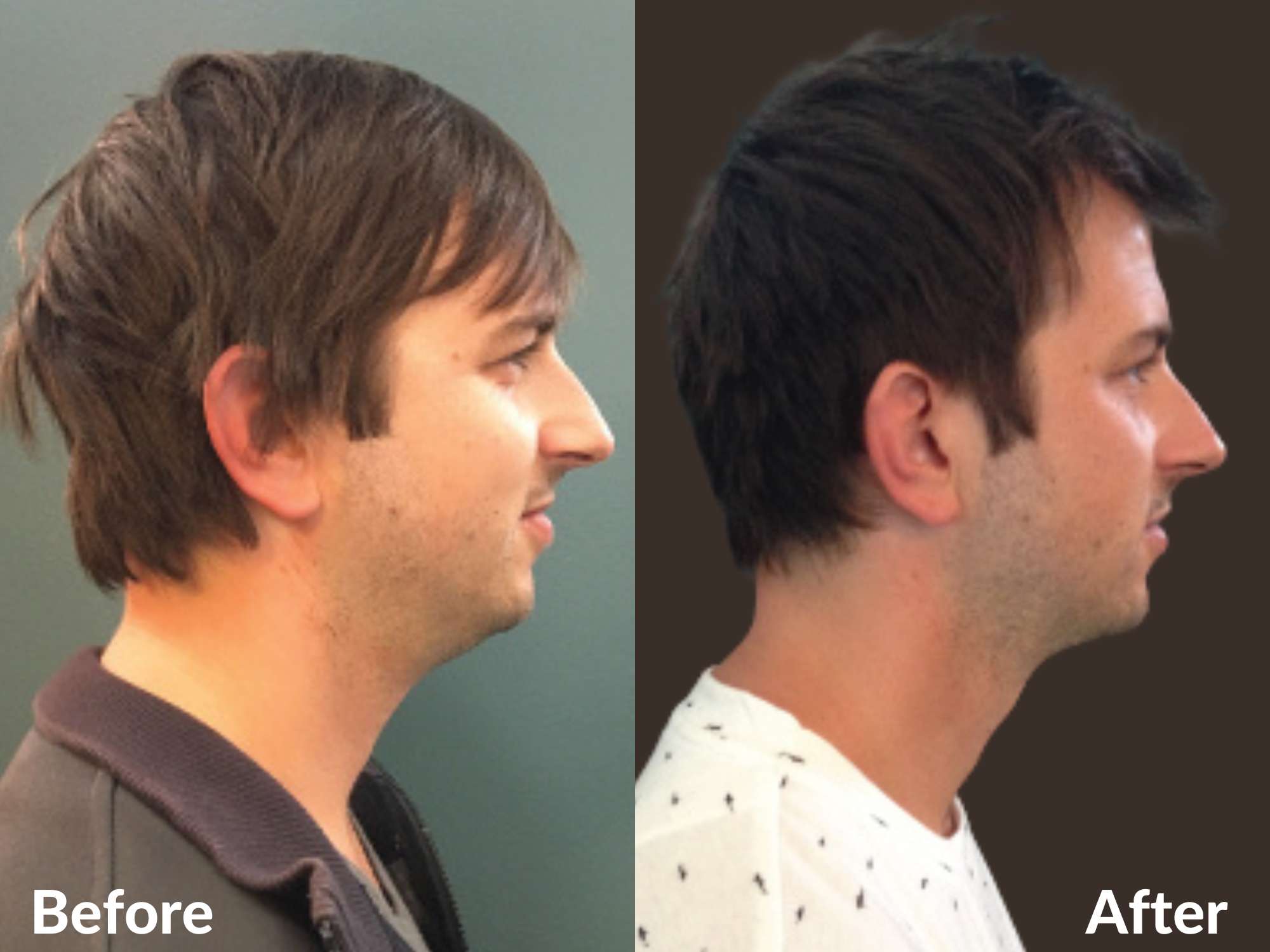 male jawline sculpting