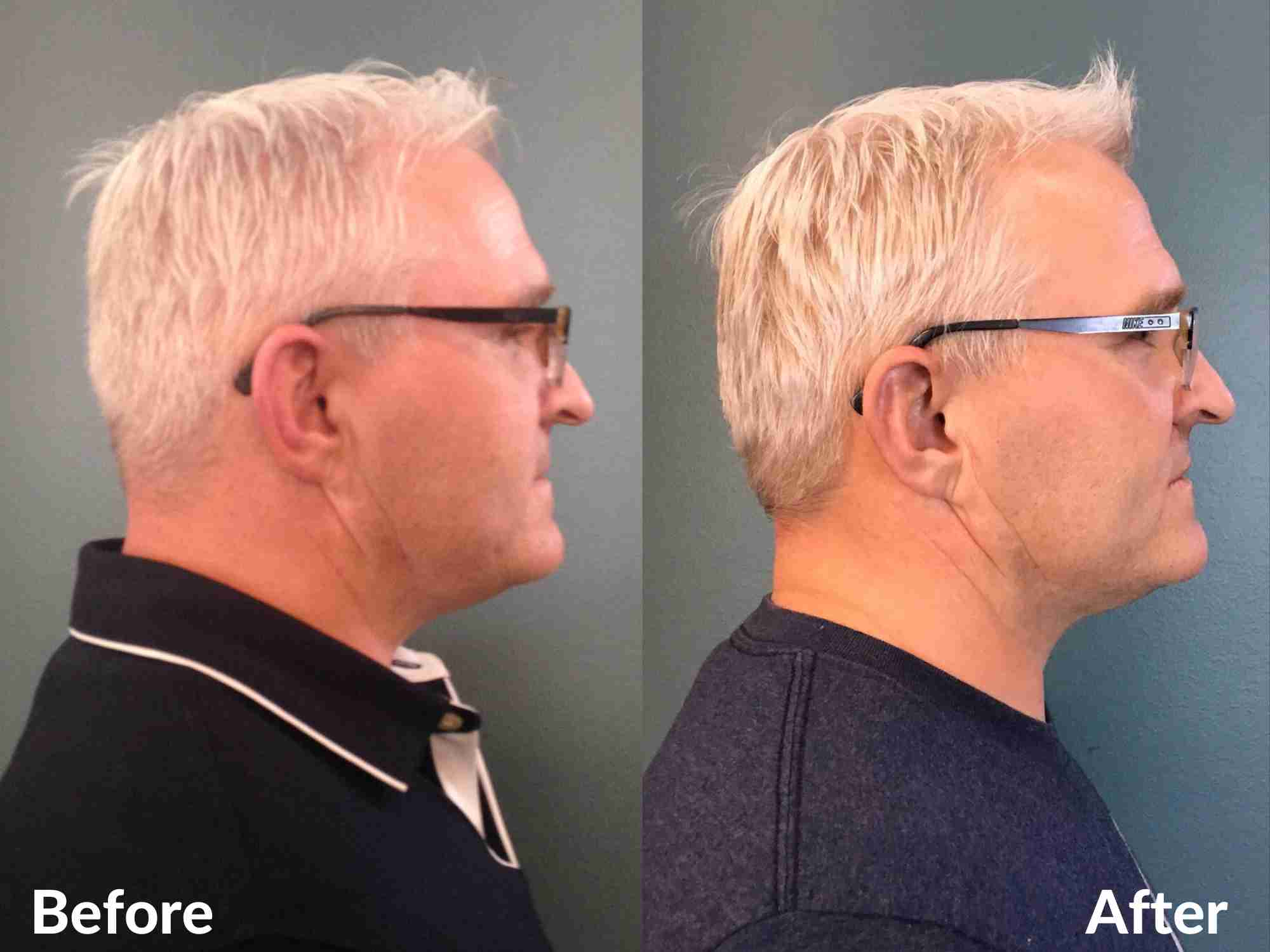 men’s jawline filler before and after