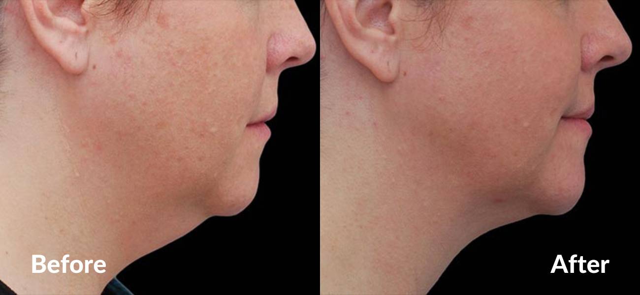 coolsculpting for double chin before and after