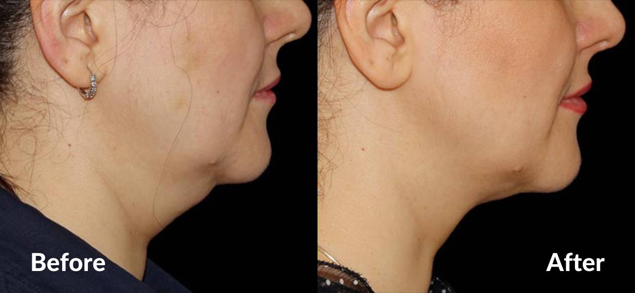 coolsculpting for double chin