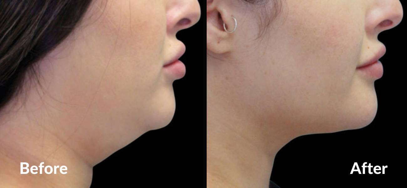 coolsculpting for double chin before and after