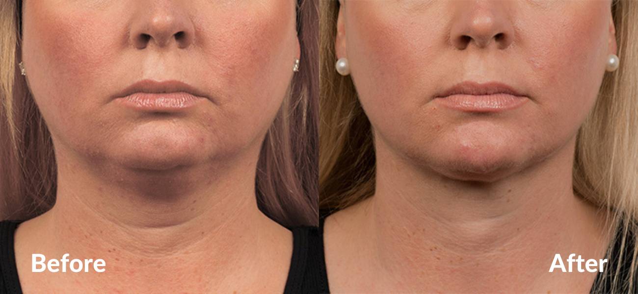 coolsculpting before and after