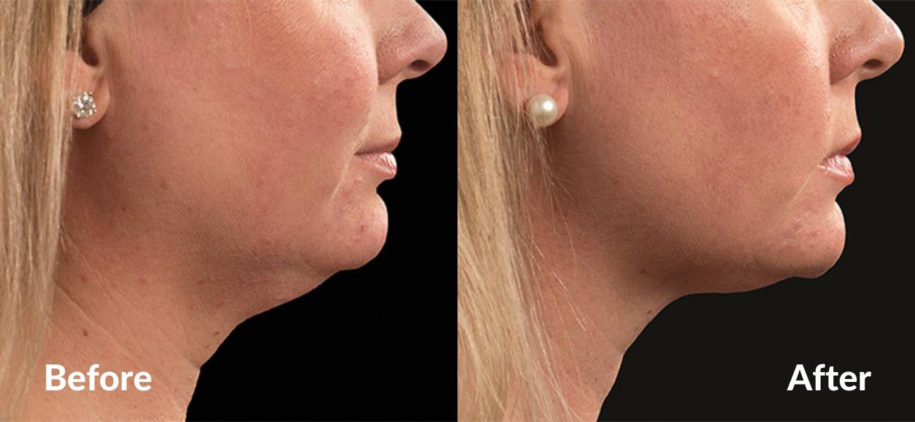 double chin coolsculpting