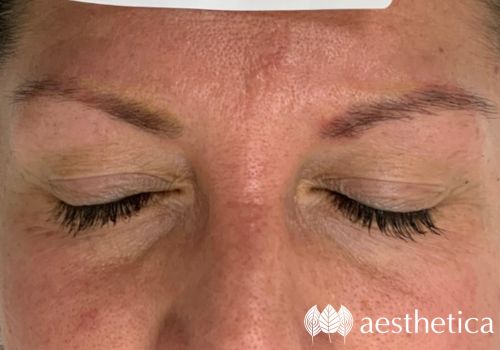 microblading removal near me