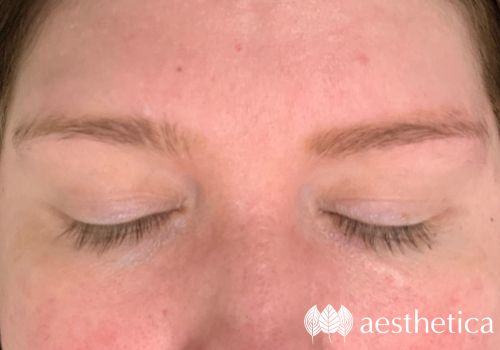 laser microblading removal