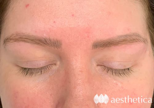 laser microblading removal