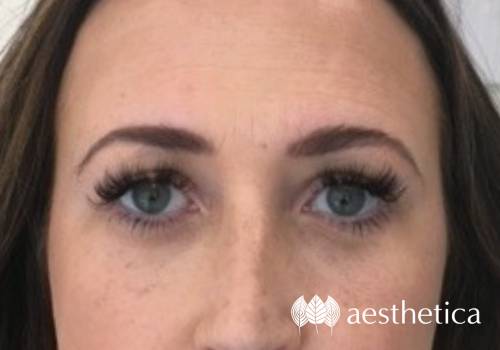 rha dermal filler