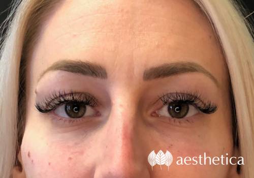 restylane under eye filler after