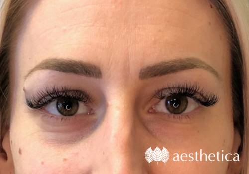 restylane under eye filler