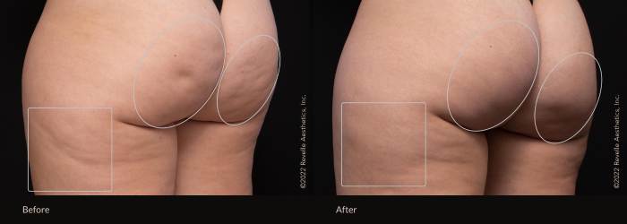 aveli is the best way to remove or get rid of cellulite