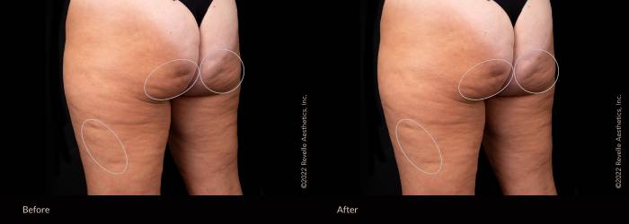 Aveli vs Cellfina vs Cellulaze