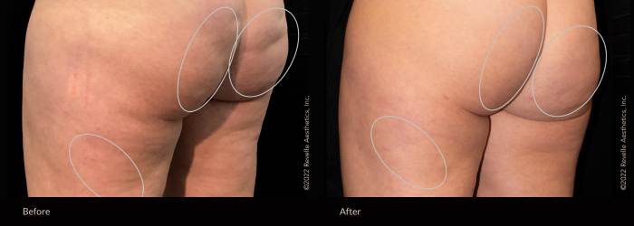 aveli before and after