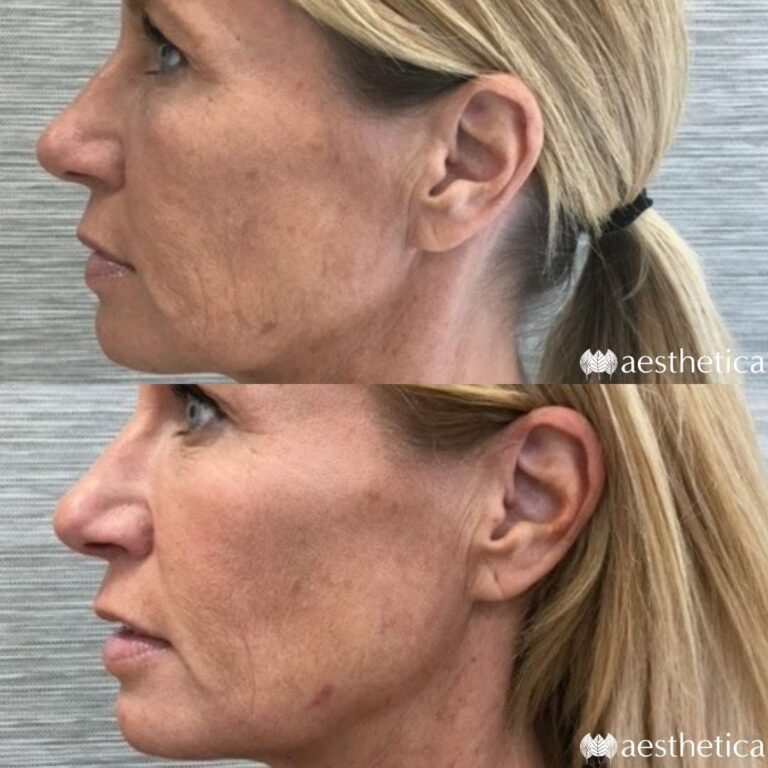 real sculptra results before and after