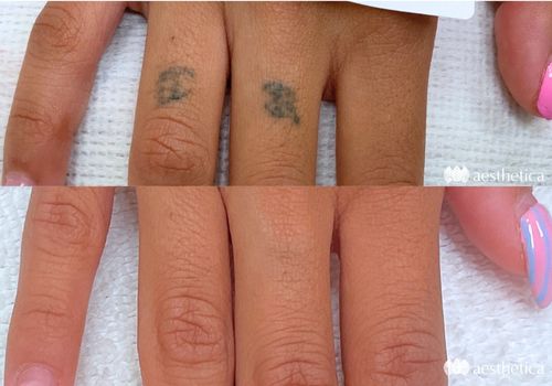 before and after laser tattoo removal