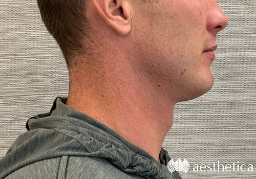 male jawline filler before
