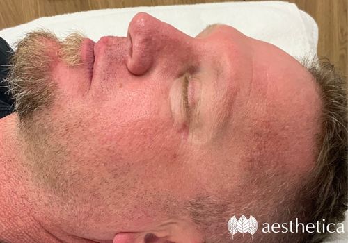 skincare treatment for men results