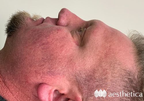 skincare treatment for men results
