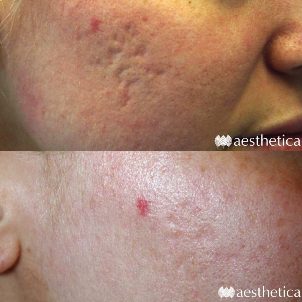acne scar before and after