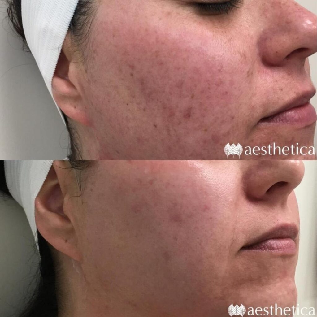 acne scar before and after