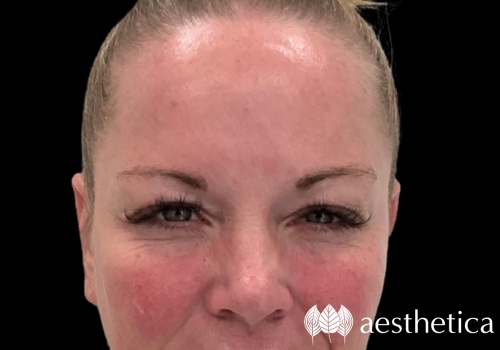 botox for frown lines after