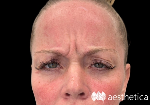 botox for frown lines before