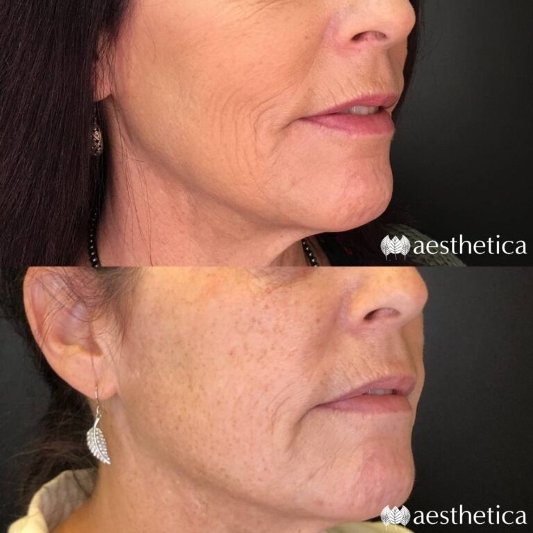 sculptra injections results