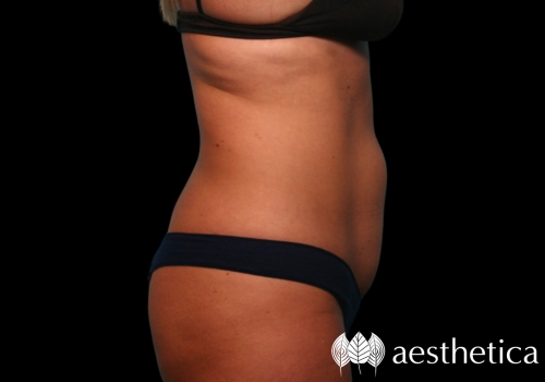 coolsculpting abdomen after