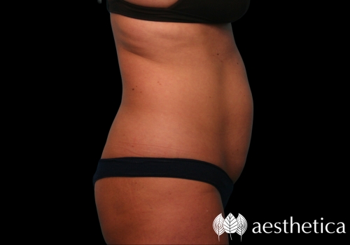 coolsculpting abdomen before