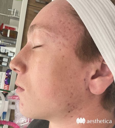 aviclear before and after