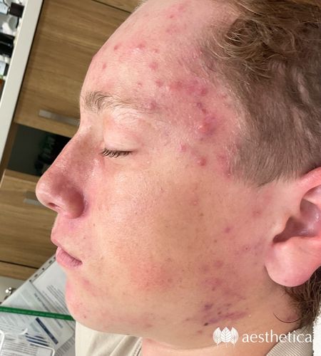 aviclear before and after