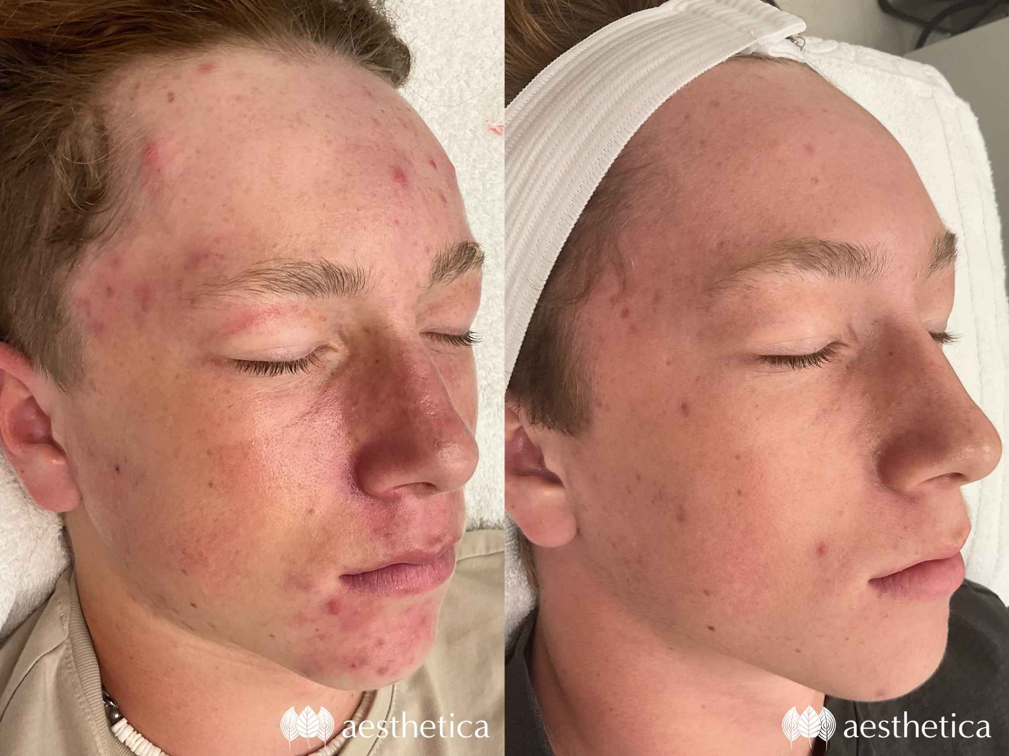 aviclear before and after by april