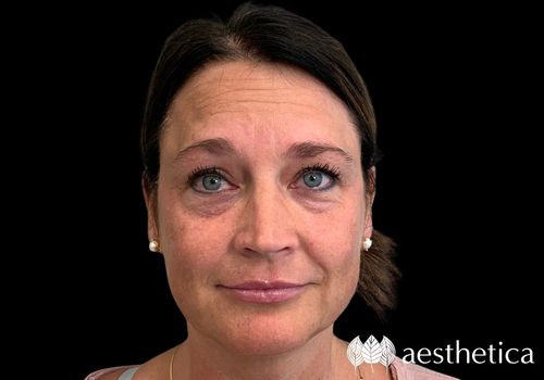 botox and juvederm filler before photo (1)