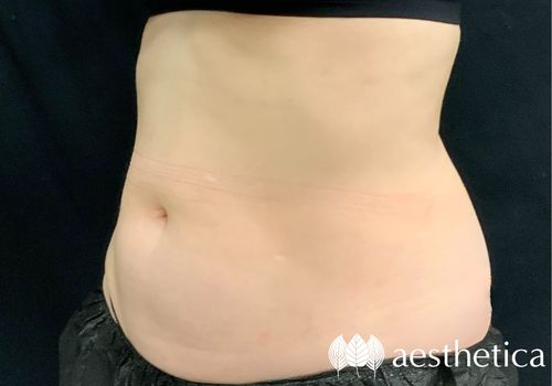 coolsculpting-woman-stomach-after