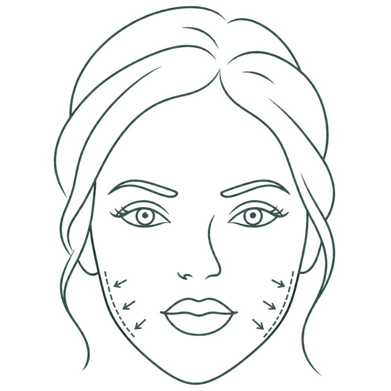 masseter botox for slimming
